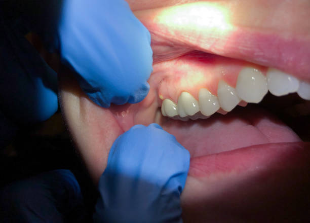 Best Emergency Treatment for Dental Infections or Abscesses in Calumet Park, IL